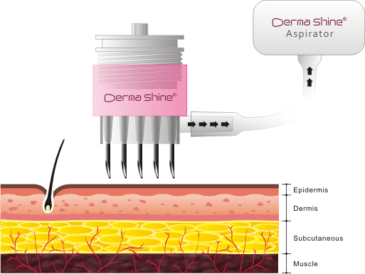 더마샤인 물광피부 시술과정 애니메이션 — 피부 단면(Epidermis·Dermis·Subcutaneous·Muscle)에 다침 헤드가 들어가 흡입(Aspirator)과 함께 진피에 주입하는 도식